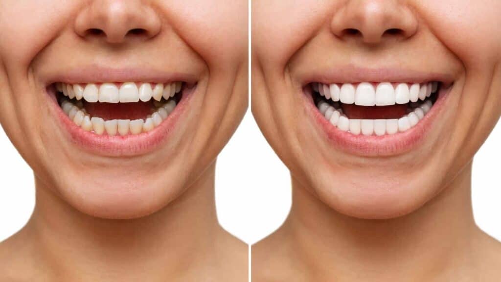 Contact Aspire White for teeth whitening services – Get in touch with Exeter today
