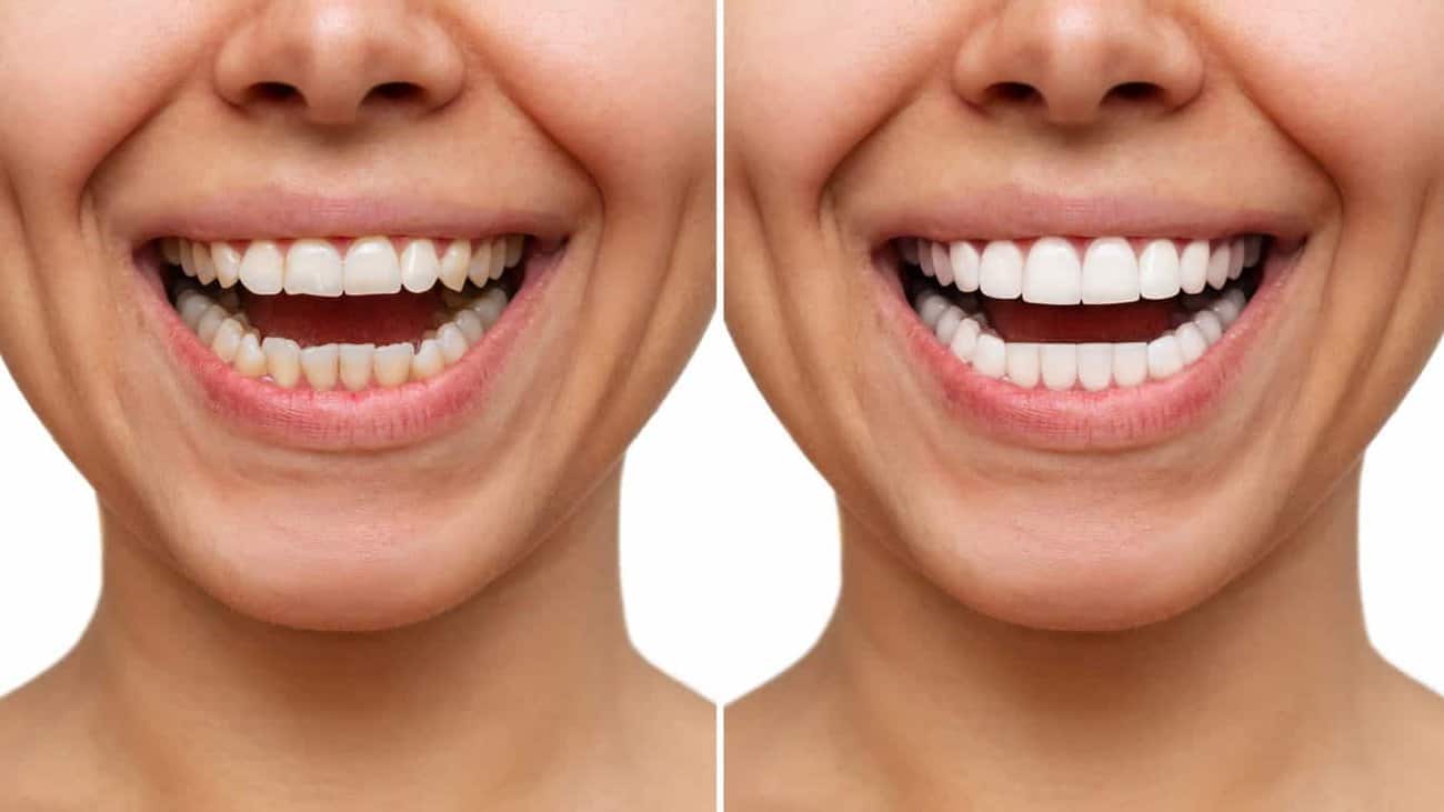 Contact Aspire White for teeth whitening services – Get in touch with Exeter today