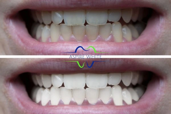 1 hour laser teeth whitening before and after results Exeter