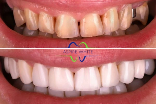 Before And After Results Exeter