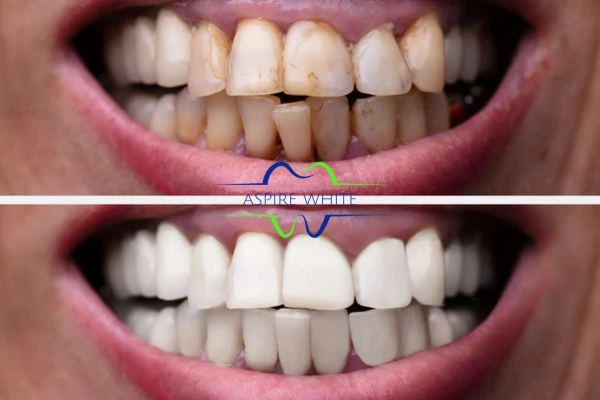 Before and after results of laser teeth whitening Exeter Book in online today!