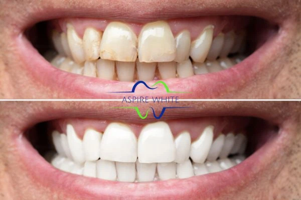 Achieve a radiant smile with professional laser teeth whitening Exeter